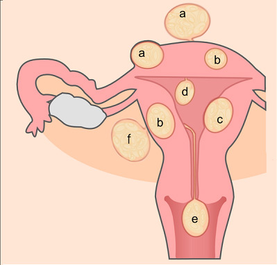 Uterine Fibroids in Pregnancy – What You Should Know